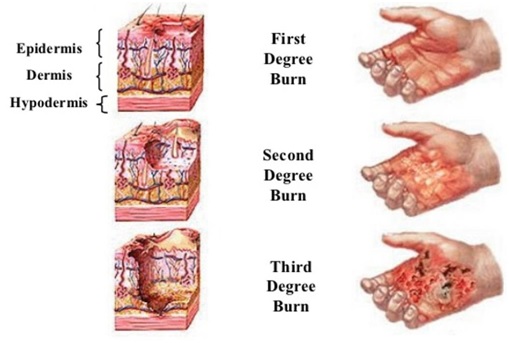 Derajat Luka Bakar